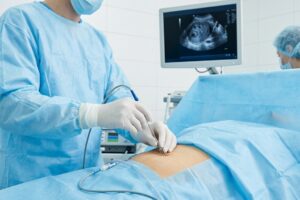 Miomas uterinos: la técnica que busca tratarlos sin extirpar el útero