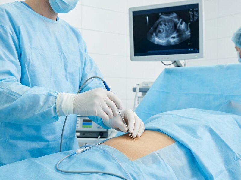 Miomas uterinos: la técnica que busca tratarlos sin extirpar el útero